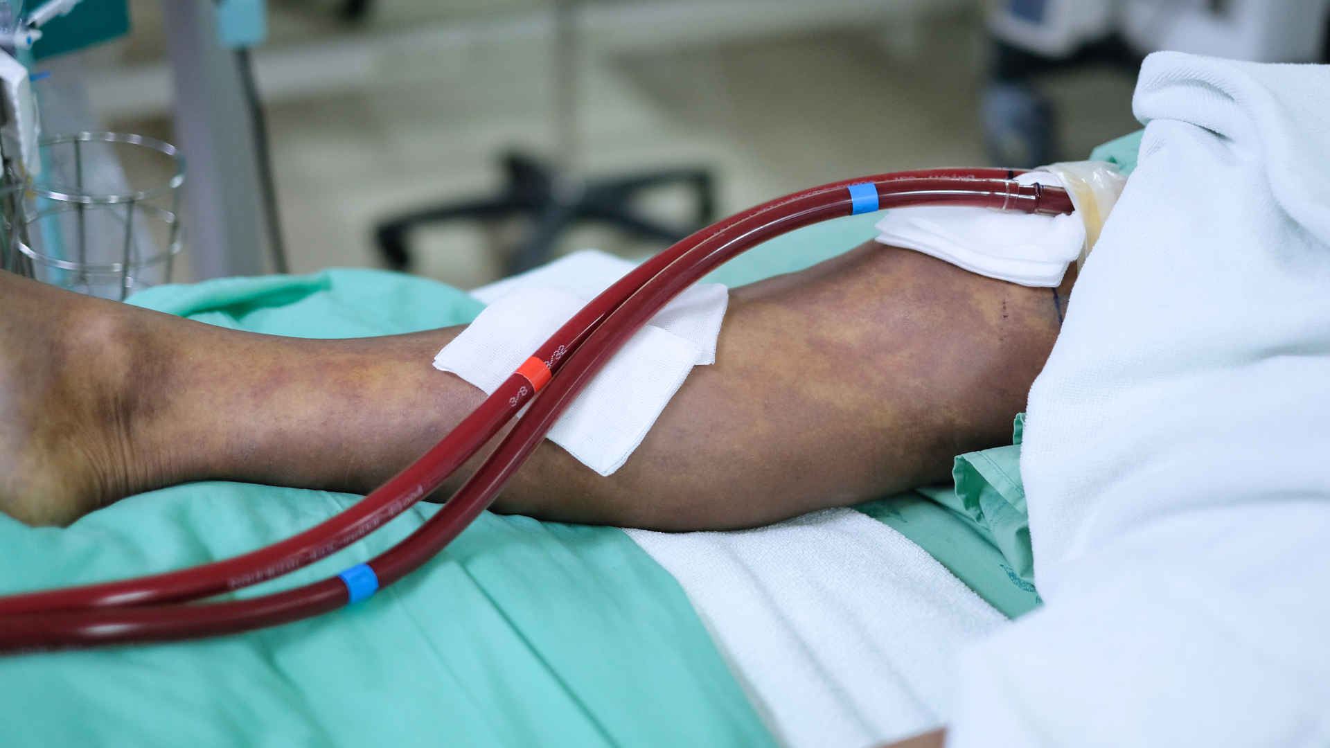 ECCO2R cannulae protruding from a patient's leg