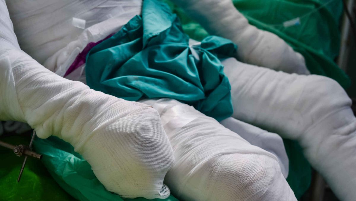 Burns patient with dressings