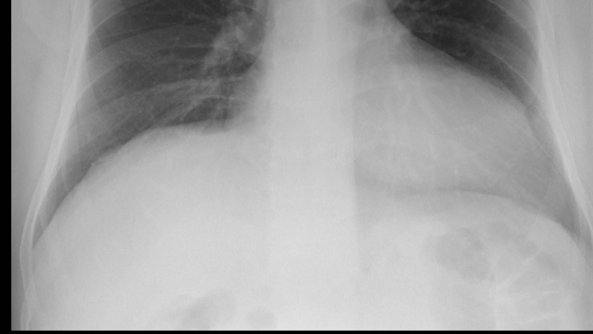 Chest radiograph of left lower lobe collapse
